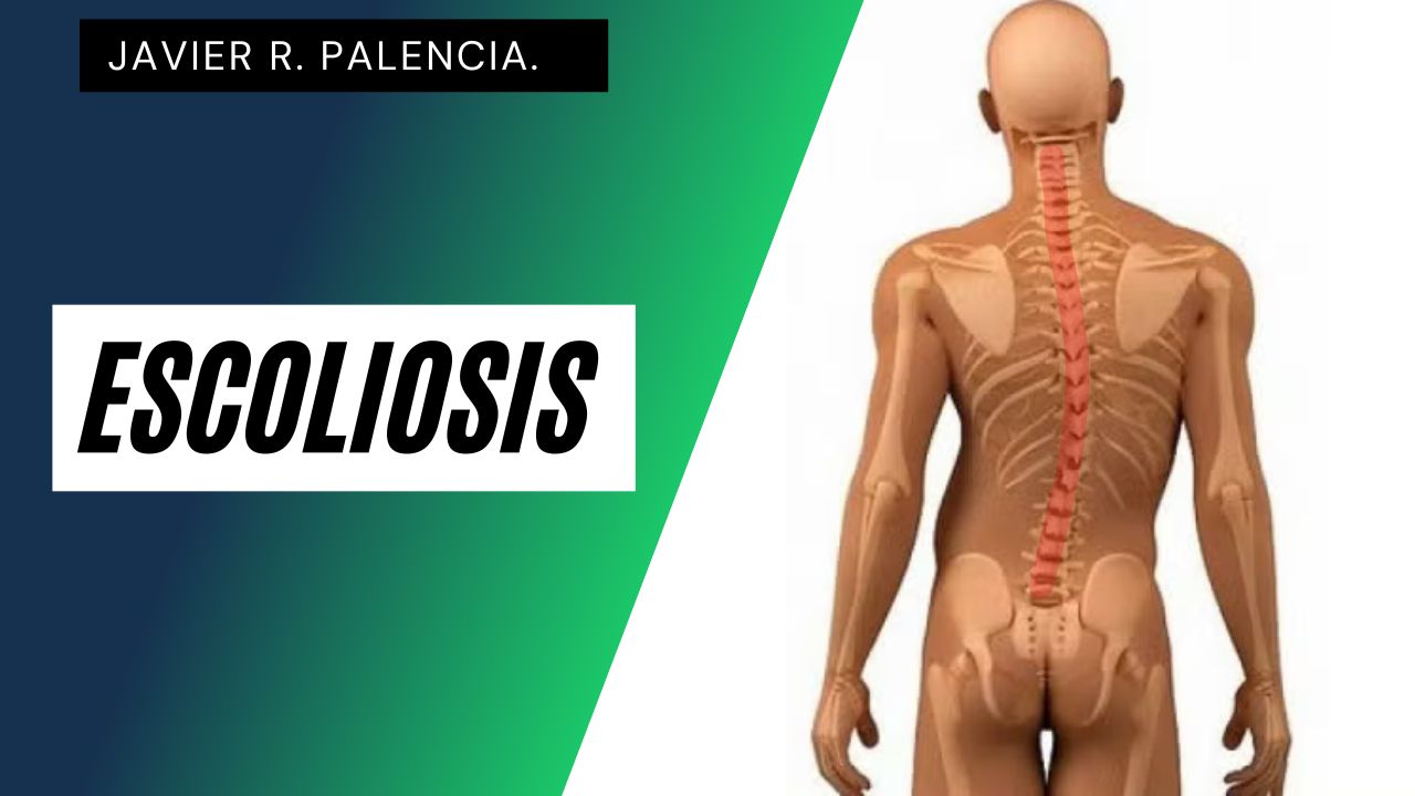 LA ESCOLIOSIS.